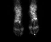 Osteoid Osteoma 2nd Toe Bone Scan